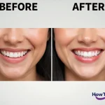 How to Pay for Veneers